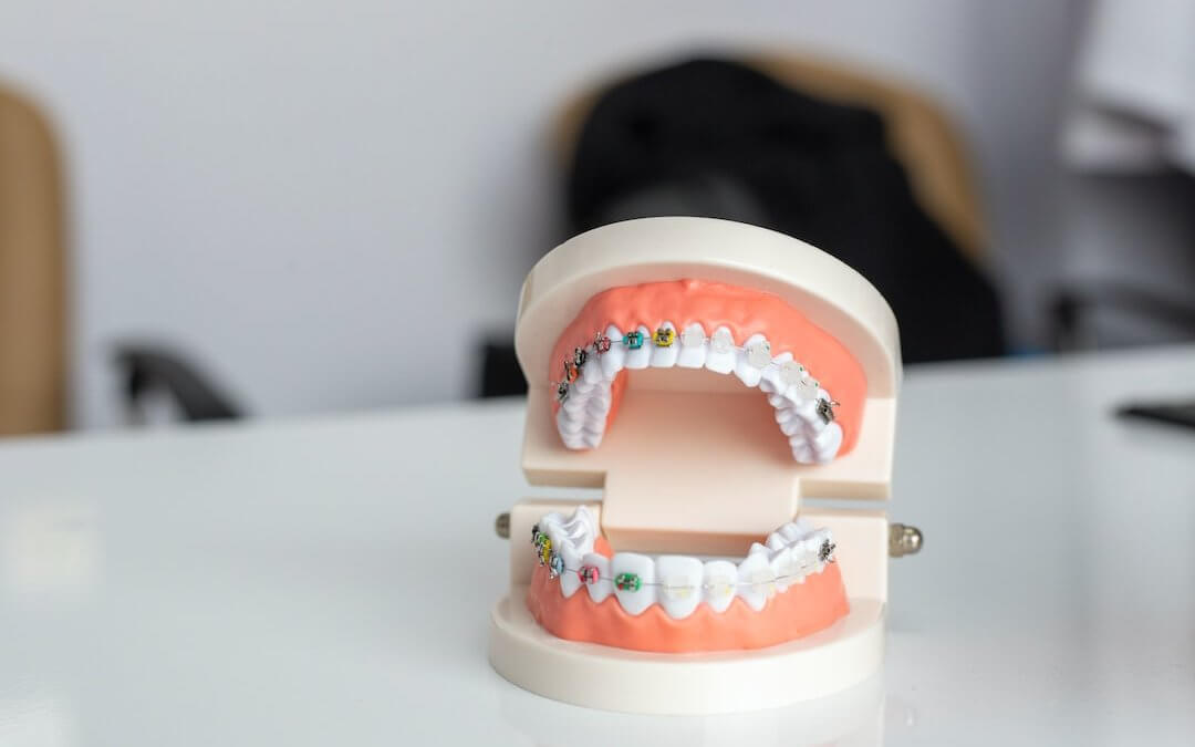types of braces