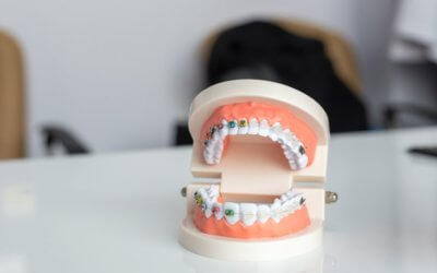 A Guide to the Different Types of Braces